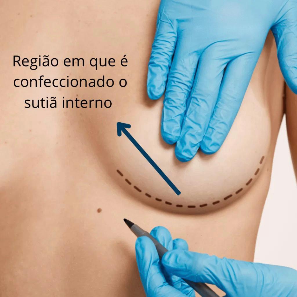 MASTOPEXIA DUAL PLANE SOUTIEN INTERNO E ALÇA MUSCULAR - Dr. Daniel  Vasconcellos